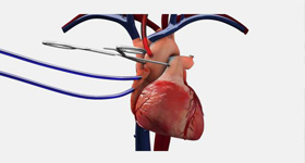 心脏医学动画  MG动画